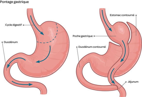 bypass-gastrique-cabinet-de-chirurgie-g-n-rale-et-de-l-ob-sit-f-s